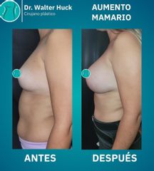 Aumento Mamario -  Walter Gabriel Huck - Centro Médico Alvear