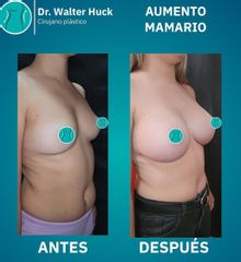 Aumento Mamario -  Walter Gabriel Huck - Centro Médico Alvear