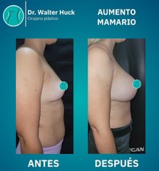 Aumento Mamario -  Walter Gabriel Huck - Centro Médico Alvear
