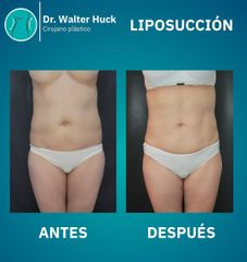 Liposucción -  Dr. Walter Gabriel Huck - Centro Médico Alvear