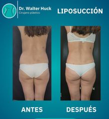 Liposucción - Dr. Walter Gabriel Huck - Centro Médico Alvear
