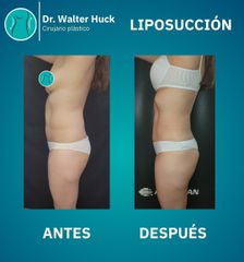 Liposucción - Dr. Walter Gabriel Huck - Centro Médico Alvear