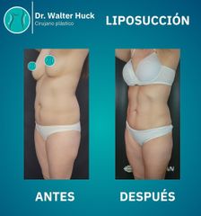 Liposucción - Dr. Walter Gabriel Huck - Centro Médico Alvear
