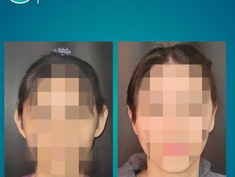 Otoplastia antes y después - 877070