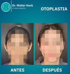 Otoplastía - Dr. Walter Gabriel Huck - Centro Médico Alvear