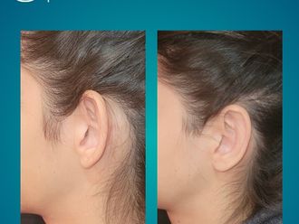 Otoplastia antes y después - 877071
