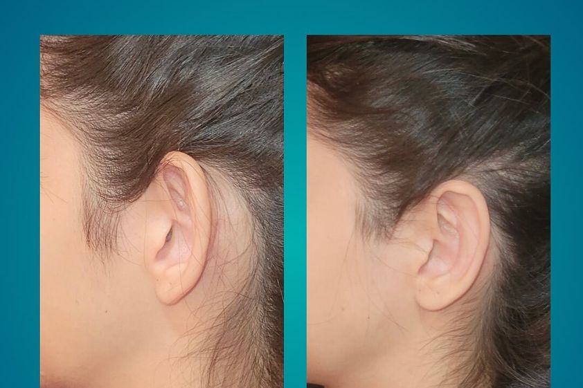 Otoplastia antes y después - 877071