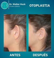 Otoplastía - Dr. Walter Gabriel Huck - Centro Médico Alvear