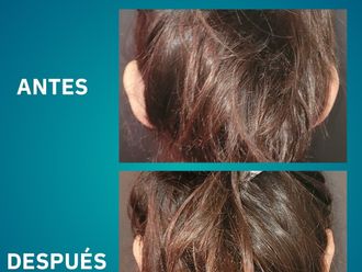 Otoplastia antes y después - 877072