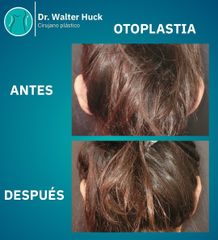 Otoplastia - Dr. Walter Gabriel Huck - Centro Médico Alvear