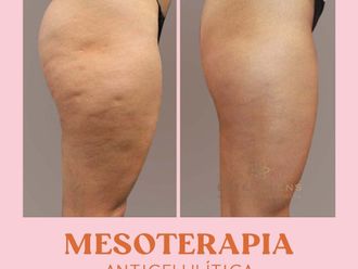 Mesoterapia antes y después - 809056