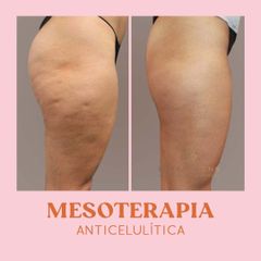 Mesoterapia - Esteticiens