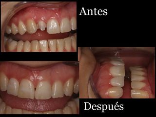 Antes y Después