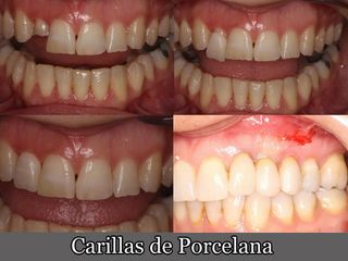 Carillas de Porcelana