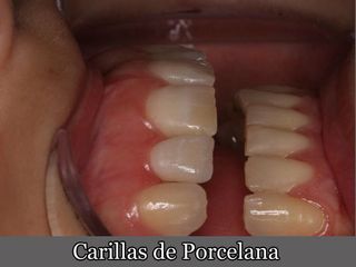 Carillas de Porcelana