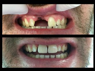 Implantes dentales - 630057
