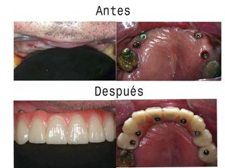 antes y despues proceso.