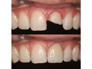 antes y despues carilla dental - dr. andres isa pavia