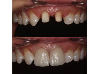 antes y despues corana de porcelana pura - dr. andres isa pavia