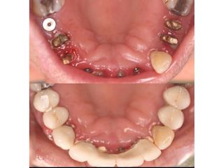 Implantes dentales - Andrés Isa Pavia