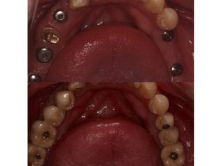 Implantes dentales - Andrés Isa Pavia