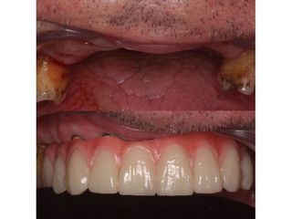 Implantes dentales - Andrés Isa Pavia