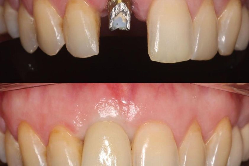Implantes dentales antes y después - 788630
