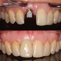 Implantes dentales - Andrés Isa Pavia