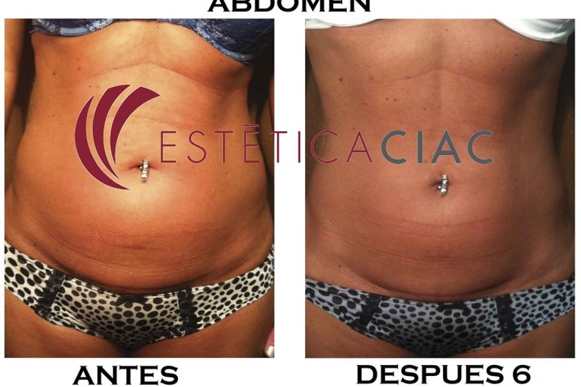 Radiofrecuencia antes y después - 634036