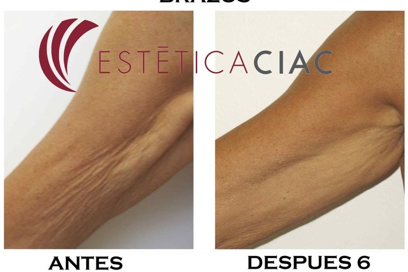 Ultracavitación antes y después - 634037