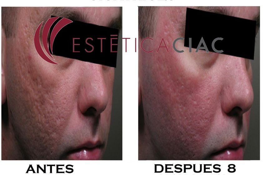 Plasma Rico en Plaquetas antes y después - 634038