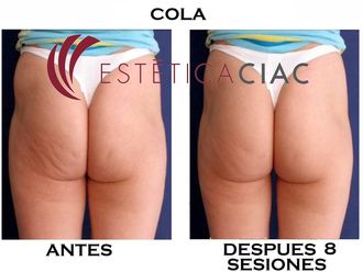 Radiofrecuencia antes y después - 634039