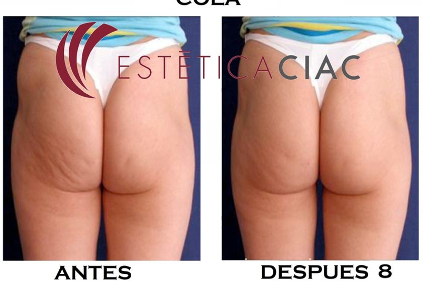 Radiofrecuencia antes y después - 634039