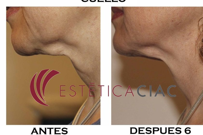 Peeling antes y después - 634041