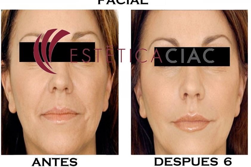 Ácido hialurónico antes y después - 634044