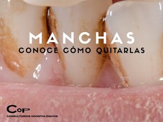 Manchas dentales - Blanqueamiento Dental Córdoba