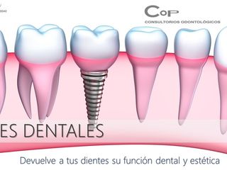 Tratamientos Odontológicos de Implantes en Córdoba