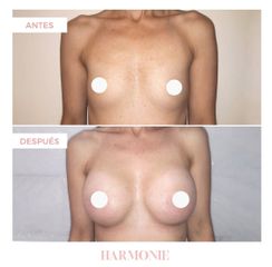 Aumento mamas - Centro De Estética Harmonie