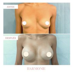 Aumento mamas - Centro De Estética Harmonie