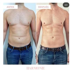 Liposucción - Centro De Estética Harmonie