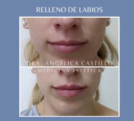 Relleno de labios - Dra. Angélica Castillo