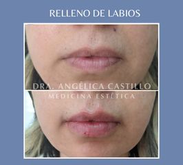 Relleno de labios - Dra. Angélica Castillo