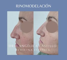 Rinomodelación  - Dra. Angélica Castillo