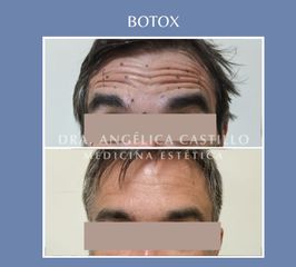 botox -  Dra. Angélica Castillo 