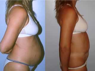 Abdominoplastía