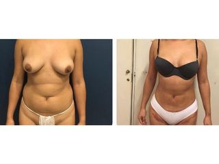 Abdominoplastia