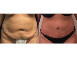 Abdominoplastia