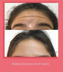 Botox - Cirugía Plástica Dra. Noelia Tarazona Duarte