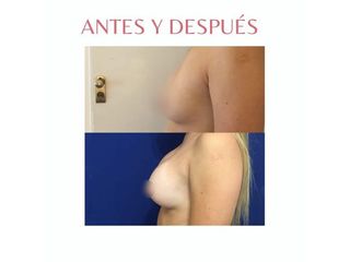 Aumento Mamas - Dra. Noelia Tarazona