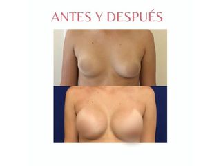 Aumento Mamas - Dra. Noelia Tarazona